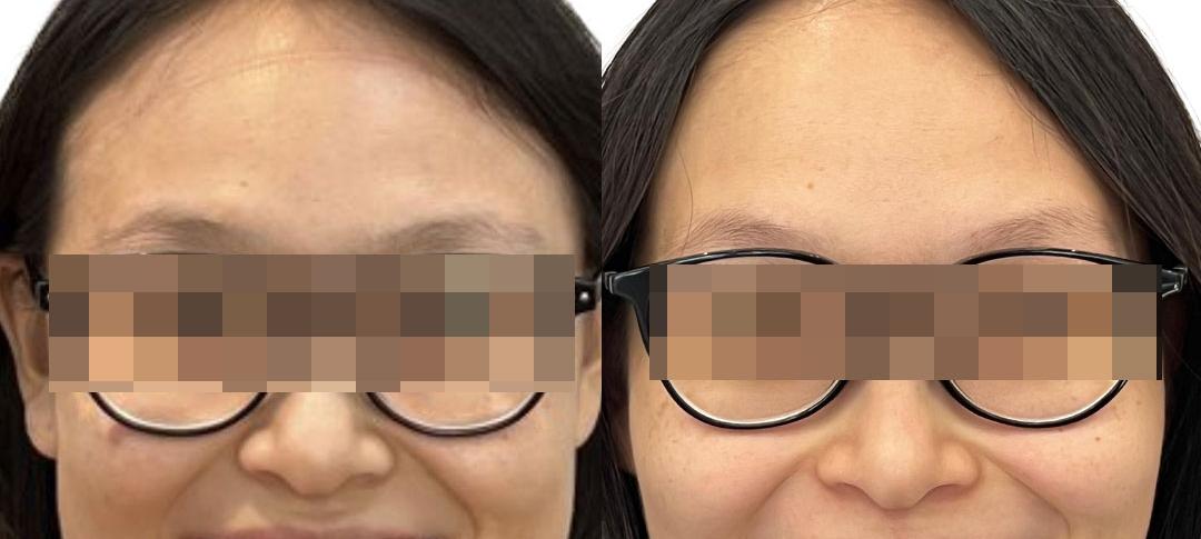 Apakah Invisalign Bisa Membuat Wajah Lebih Tirus? Fakta atau Mitos