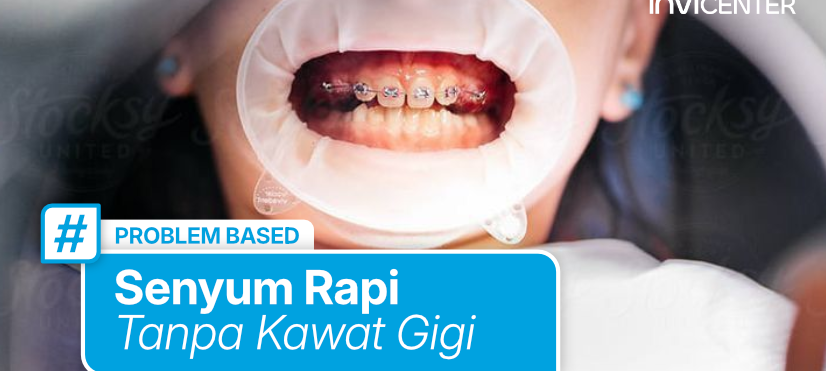 Gigi Berantakan Tapi Ragu Pakai Behel? Ini Alternatif Yang Cocok Kamu Pertimbangkan!