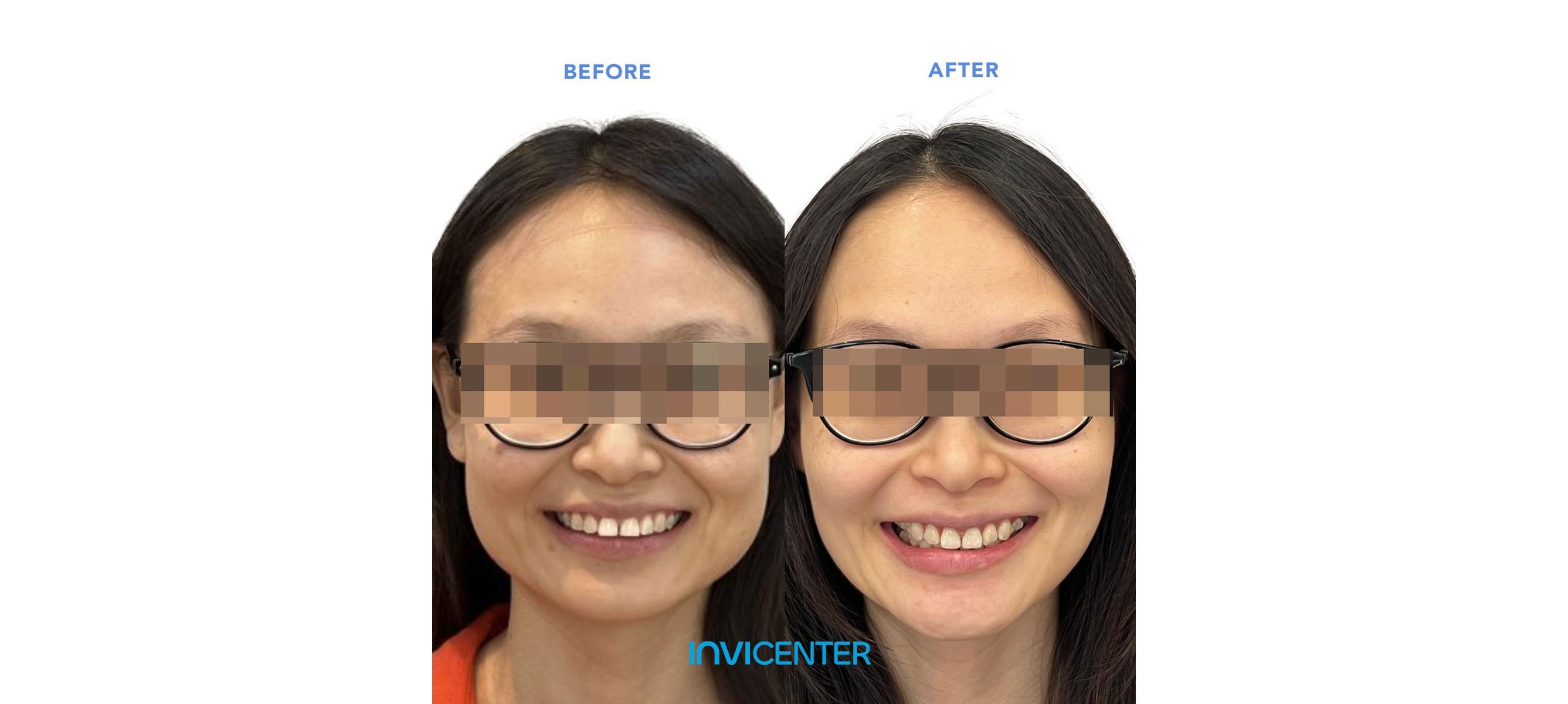 Apakah Invisalign Bisa Membuat Wajah Lebih Tirus? Fakta atau Mitos