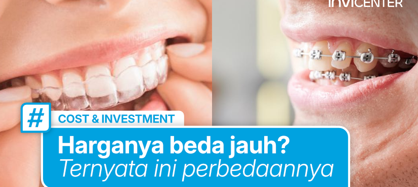 Invisalign vs Behel: Mana yang Lebih Mahal?