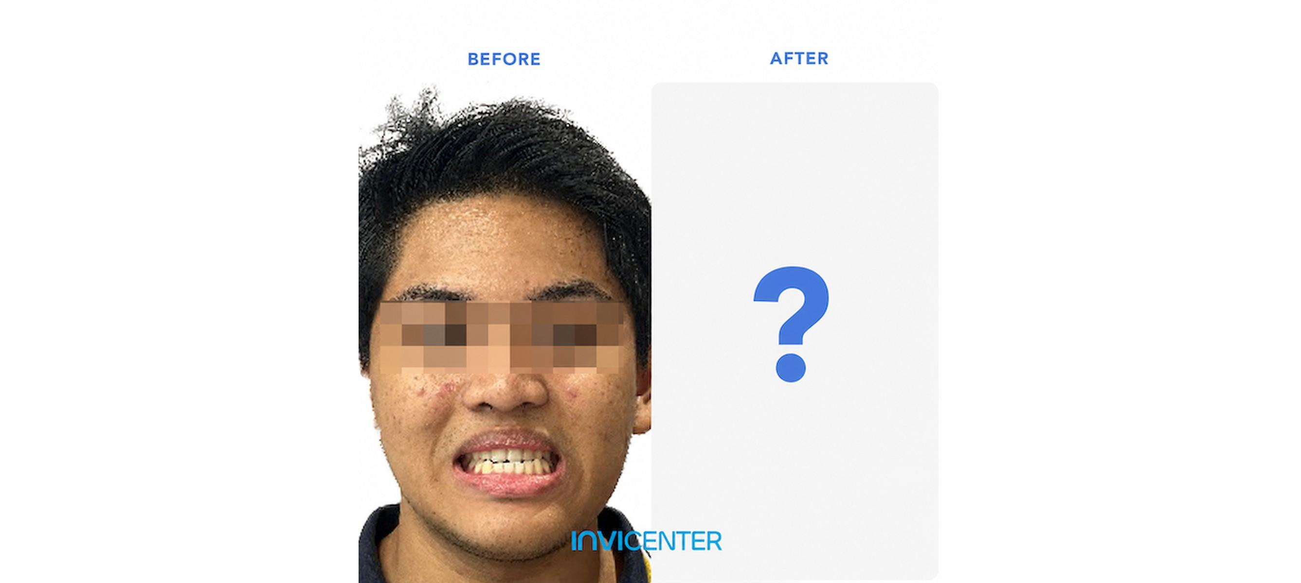 Apakah Invisalign Dapat Memperbaiki Profil Wajah?