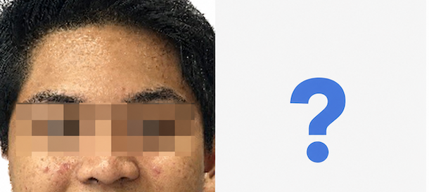 Apakah Invisalign Dapat Memperbaiki Profil Wajah?