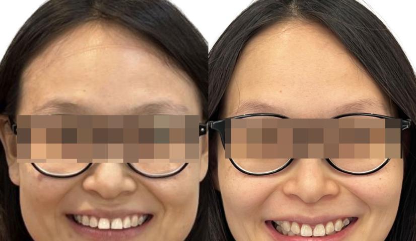 Apakah Invisalign Bisa Membuat Wajah Lebih Tirus? Fakta atau Mitos