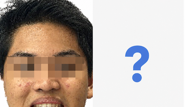Apakah Invisalign Dapat Memperbaiki Profil Wajah?
