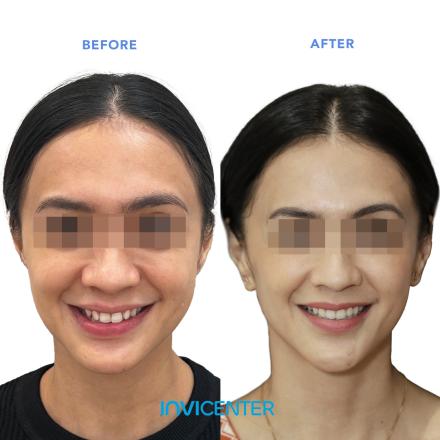 Facial Symmetry