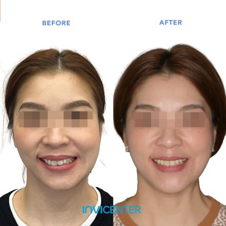 Facial Symmetry