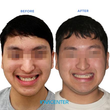 Underbite