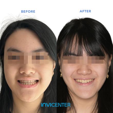 Underbite
