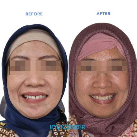 Facial Symmetry
