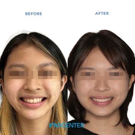 Invisalign First & Invisalign Teen