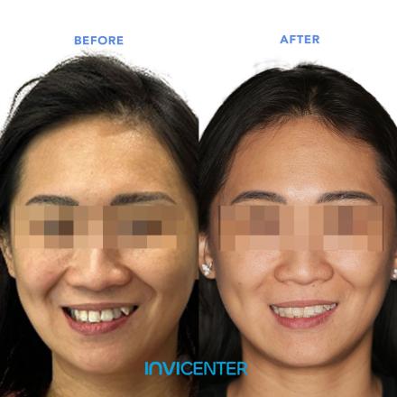 Facial Symmetry