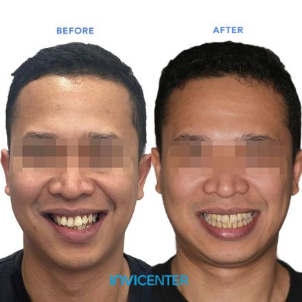 Facial Symmetry
