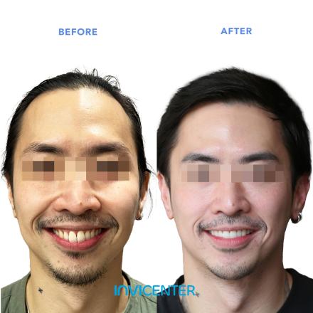 Overbite