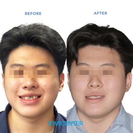 Invisalign First & Invisalign Teen