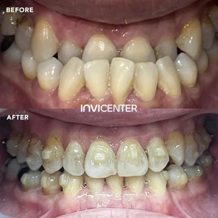 Underbite