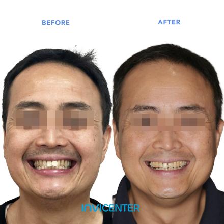 Overbite