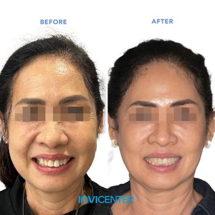 Facial Symmetry