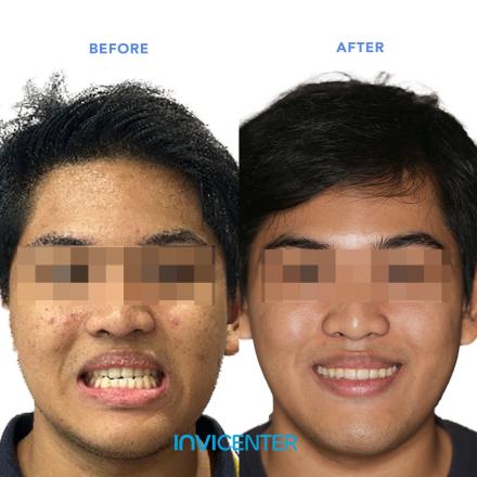 Invisalign First & Invisalign Teen